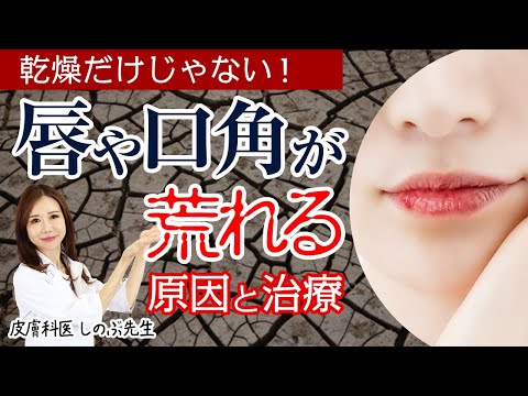 【乾燥だけじゃなかった！唇荒れや口角炎の原因】皮膚科医が教える自分でできる予防と治療法