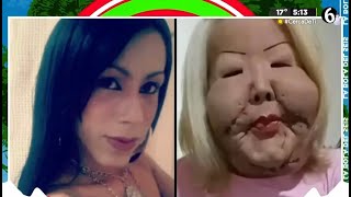 Influencer Lleva 10 Años Con Cara Desfigurada Tras Cirugías La Bola Del 6