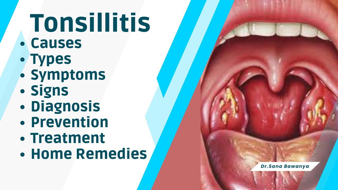 Tonsillitis Causes Types Symptoms Signs Diagnosis Preventions 