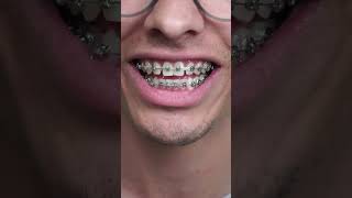 gummy mac n cheese vs braces