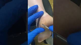 Get Rid Of Stubborn Heel Calluses! Check Out Australia's Top Podiatrist In Action.