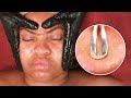 EXTREMELY SATISFYING FACIAL MASK & DERMAPLANING| Best Skincare Treatment