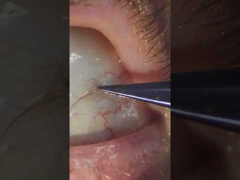 Sub-Conjunctival Eyelash Removal #shorts