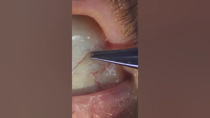 Sub-Conjunctival Eyelash Removal #shorts