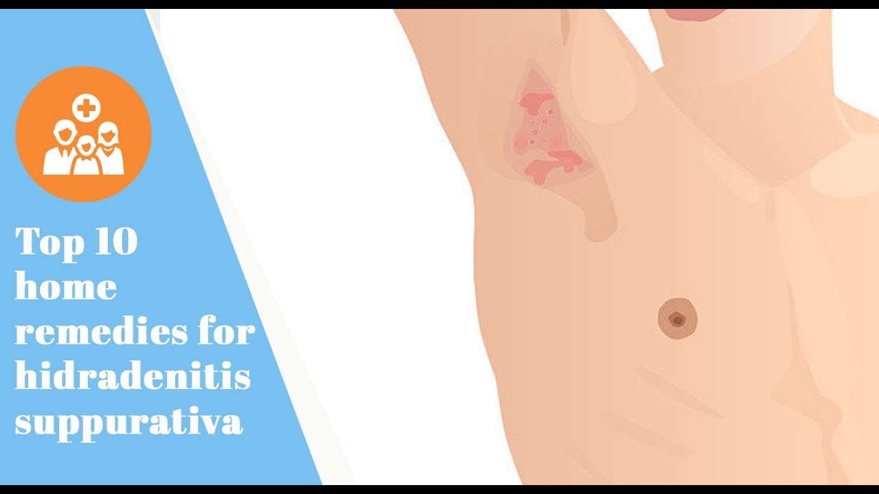Top 10 Home Remedies For Hidradenitis Suppurativa Doctor Tom YouTube