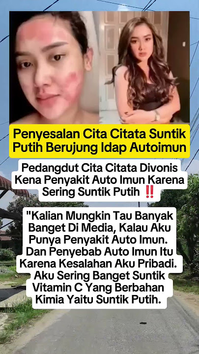 Penyebab Cita Citata Idap Auto Imun..