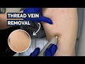Unbelievable Way to Get Rid of Thread Veins - Results You Won't Believe!