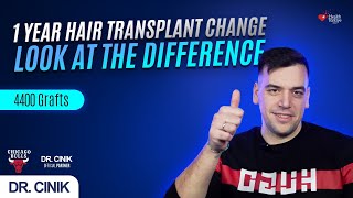 1 Year Hair Transplant Result A Year That Changed Everything