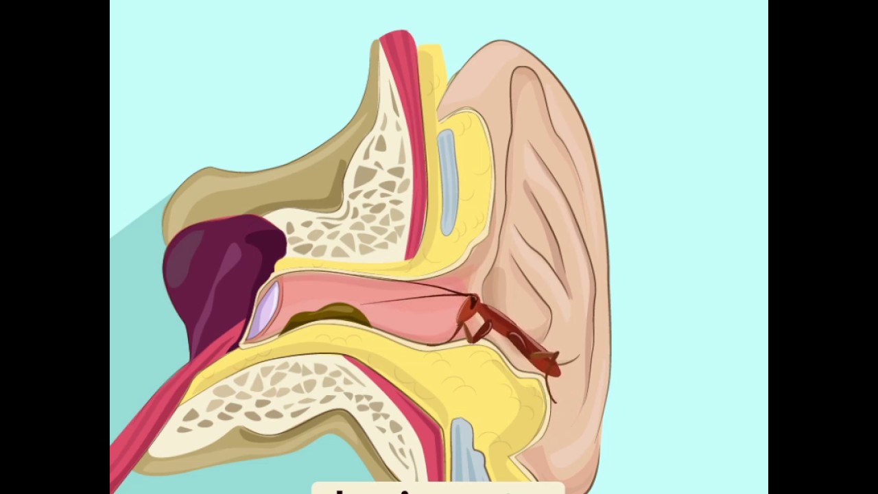 il ne faut jamais utiliser de coton tige dans l'oreille