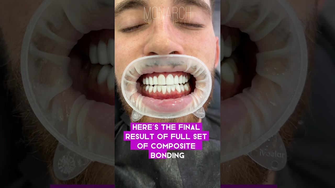 Monarch Smile Turkey — patient video