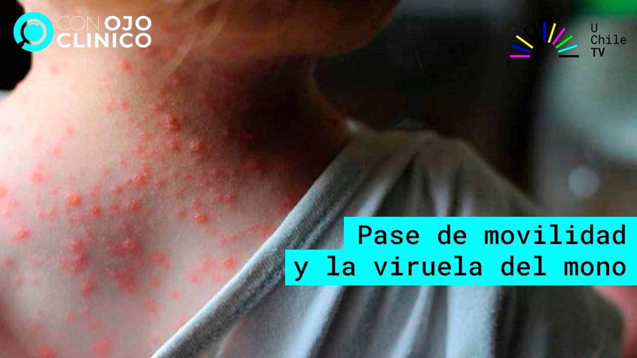 Con Ojo Clínico - CAP 48: Pase de movilidad y viruela del mono