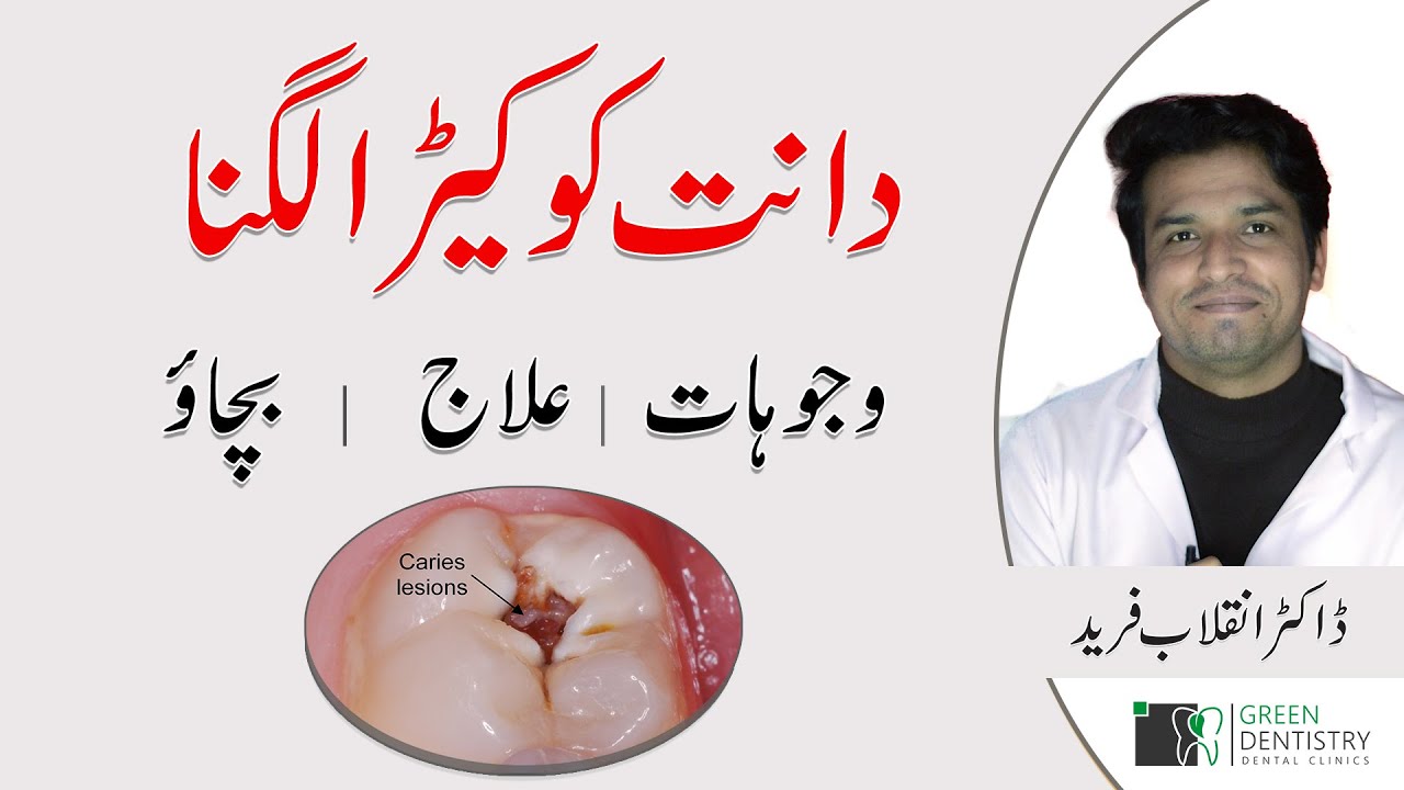 The Cavity In Teeth Causes Treatment 