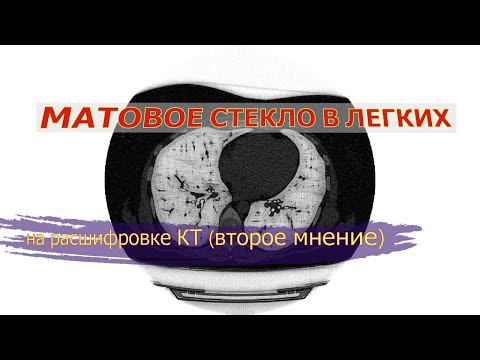 ПОЛИСЕГМЕНТАРНАЯ ПНЕВМОНИЯ (матовое стекло) при ПОРАЖЕНИИ ЛЕГКИХ 10 процентов на КТ расшифровке