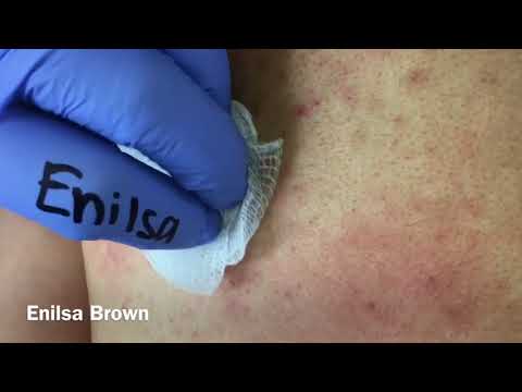 Christian&#;s Acne Back Treatment Part 