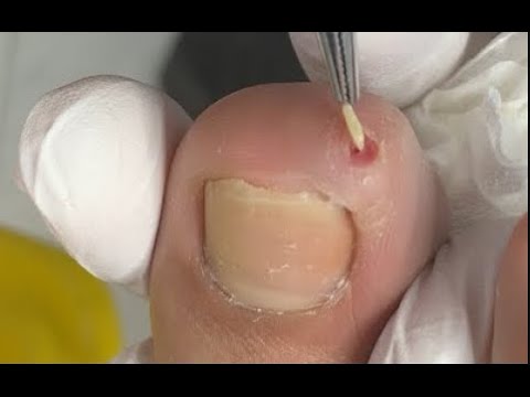 The worst  toenail  on earth!  “Thorn" inside the toe -