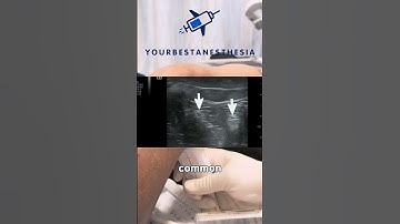 How to make your sciatic nerve blocks take effect faster