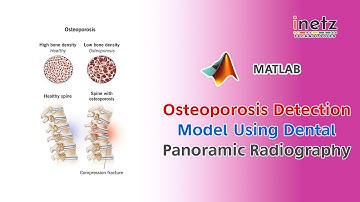 Osteoporosis Detection Model Using Dental Panoramic Radiography