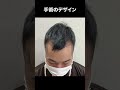 【閲覧注意】深刻なM字ハゲが植毛で大改善 #shorts