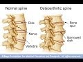 Anatomy of Spinal Arthritis Explained by Top Pain Doctor in Las Vegas, Nevada