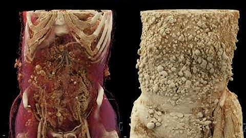 Cinematic Rendering - Clinical Applications and Future Directions Part 3