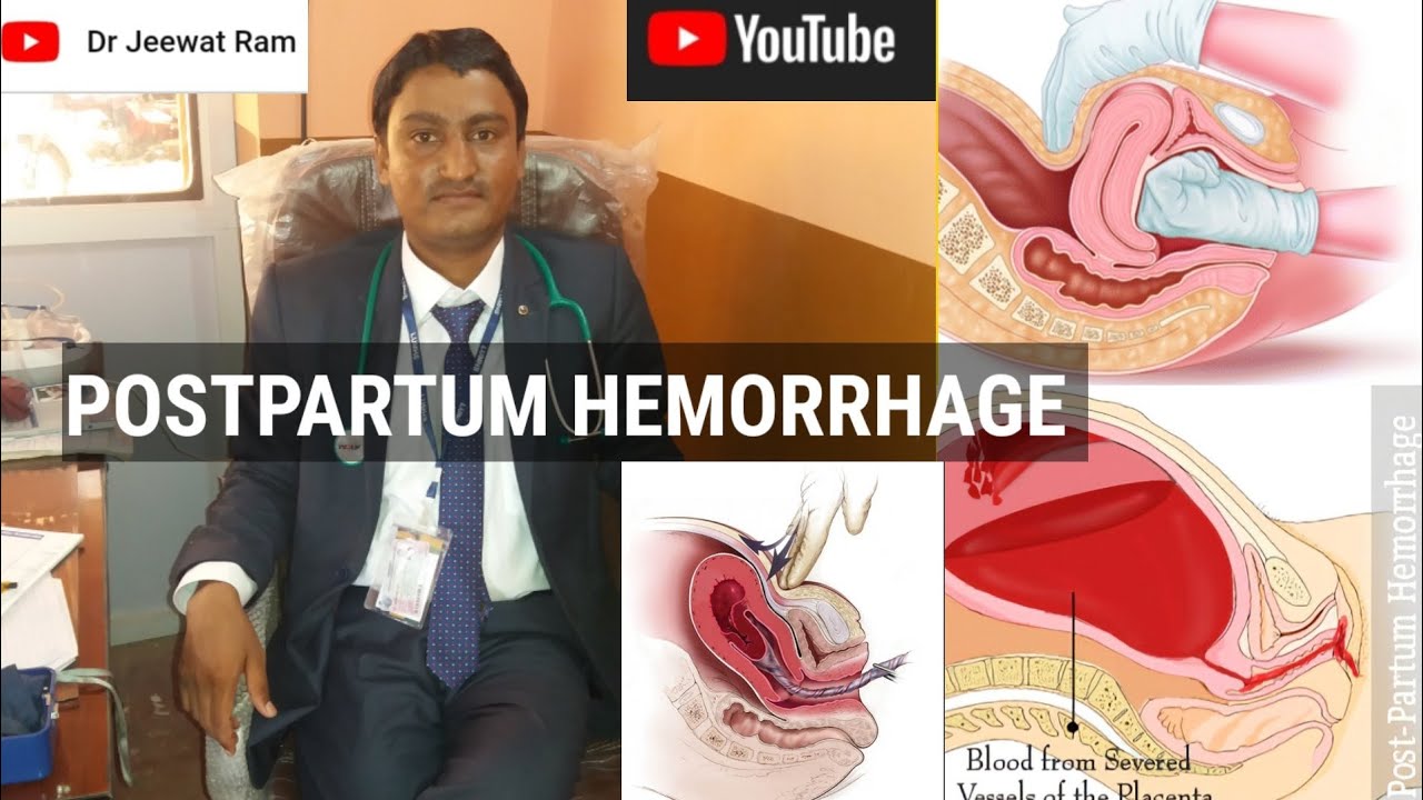 POSTPARTUM HEMORRHAGE, SIGNS, SYMPTOMS, CAUSES, DIAGNOSIS AND