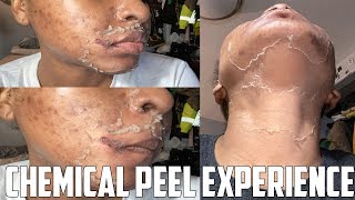 CHEMICAL PEEL EXPERIENCE | MY FIRST 4% RETINOL PEEL | BEFORE, AFTER + THE DRAMATICS | KENSTHETIC