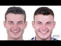 Transformación de sonrisa con carillas de porcelana - Smile transformation with porcelain veneers