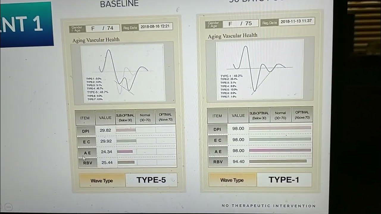 Nitric Oxide Lozenges for my Neuropathy Pain, NEO40 YouTube