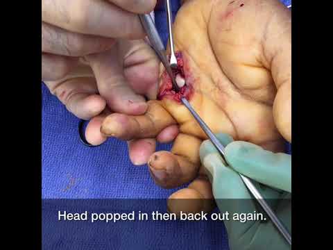 Open Reduction of MCP joint Dislocation--Plastic Surgery Austin