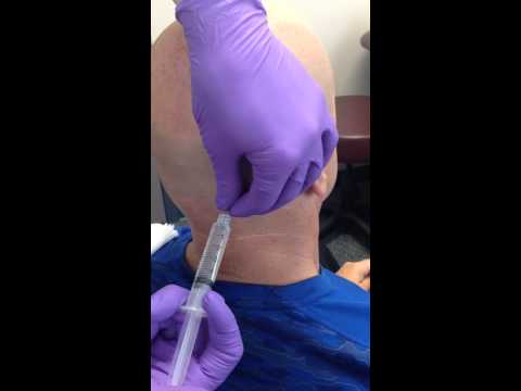What Occipital Neuralgia Treatment