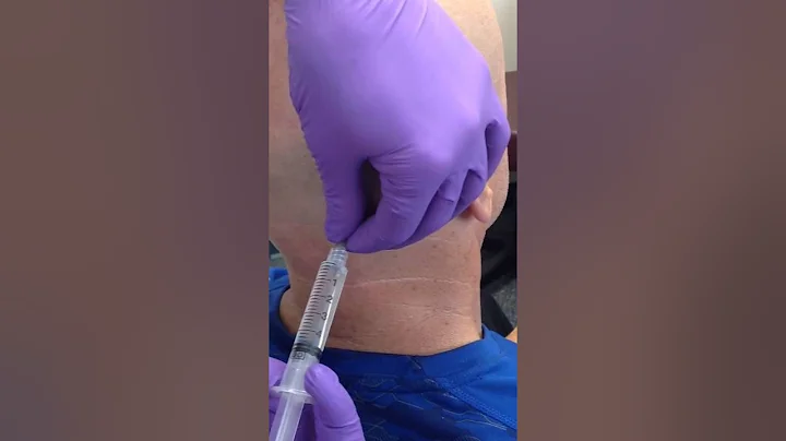 Occipital Nerve Block:  Dr Andrew Blumenfeld