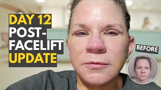 Day 12 After Facelift I Can’t Eat And My Face Is So Tight