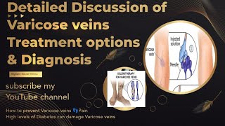 How to prevent Varicose veins | Detailed Discussion of Varicose veins