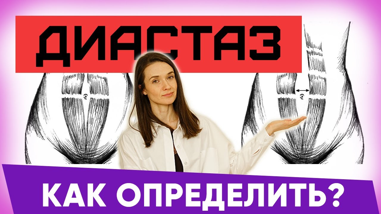 Диастaз: как определить. Диастaз что это такое. Диастаз после родов ...