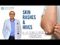 Why does Skin Rash, Hives, Urticaria happen? | Dr Rohit Batra explains