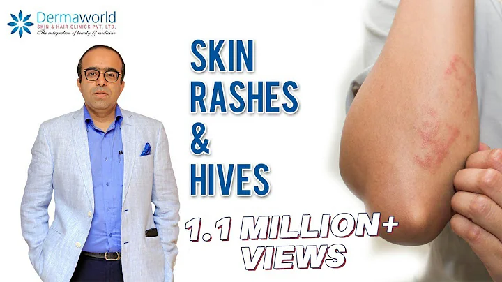 Why does Skin Rash, Hives, Urticaria happen? | Dr Rohit Batra explains - DayDayNews
