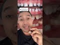 SYARAT PENGGUNAAN GC TOOTH MOUSE YG EFEKTIF ADALAH GIGI ANAK YG FREE KARIES #gctoothmouse #gigianak