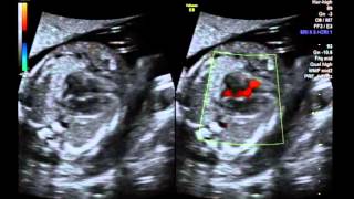 DORV uncommitted VSD  normal GA: Overview
