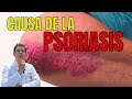 Causas de la Psoriasis (Dr Javier E Moreno)