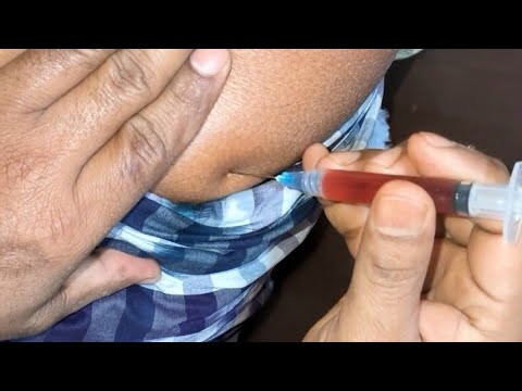 Buttock Im Intramuscular Vitamins B1 B6 B12 injection Video. 25 Ep -54 ...