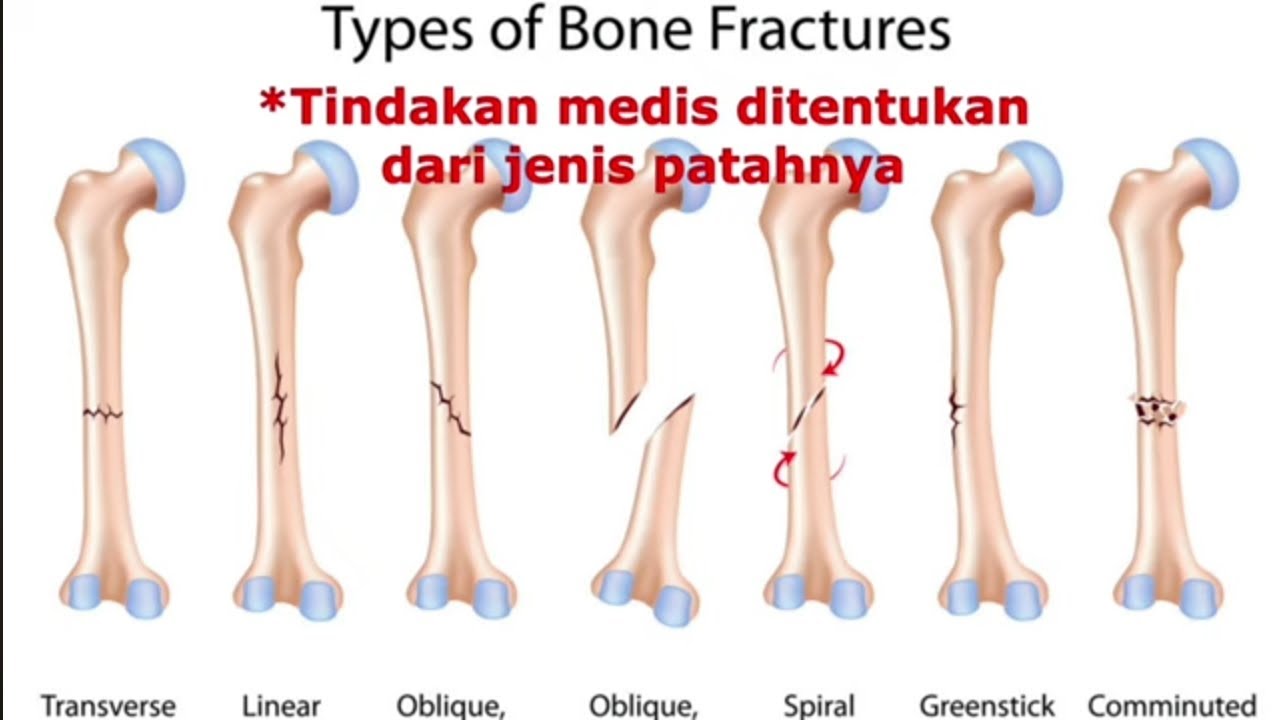 Day 34 fraktur tibia dan fibula,menjawab pertanyaan minggu keberapa ...