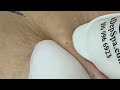 Прыщи / Огромные прыщи / Релакс с акне / Выдавливание прыщей / Черная точка  #Прыщи