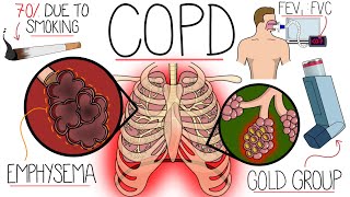 Understanding Chronic Obstructive Pulmonary Disease (COPD Explained Clearly) by Rhesus Medicine 34,566 views 6 months ago 13 minutes, 3 seconds