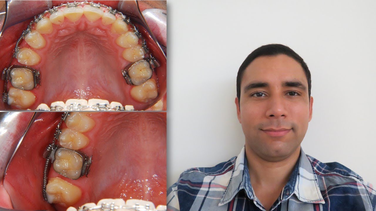 Distalar Molares Superiores: Presentación de un paciente.