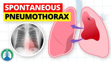 Spontaneous Pneumothorax | Lung Collapse Causes and Prevention