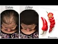 the Indian secret, 🌶️ to grow hair at a rocket speed and treat baldness from the first week