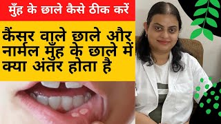 Why Mouth Ulcers Happen? Difference Between Normal Mouth Ulcers And Cancer Ulcers