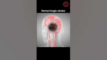 Het doel van het behandelen van een hersenbloeding, #beroerte #bloeding