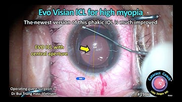 CataractCoach™ 1986: EVO Visian ICL for high myopia