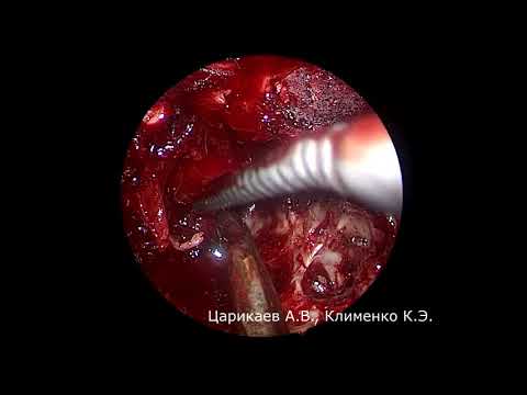 Аденома гипофиза. Транссфеноидальная эндоскопическая хирургия в 4 руки. 18+